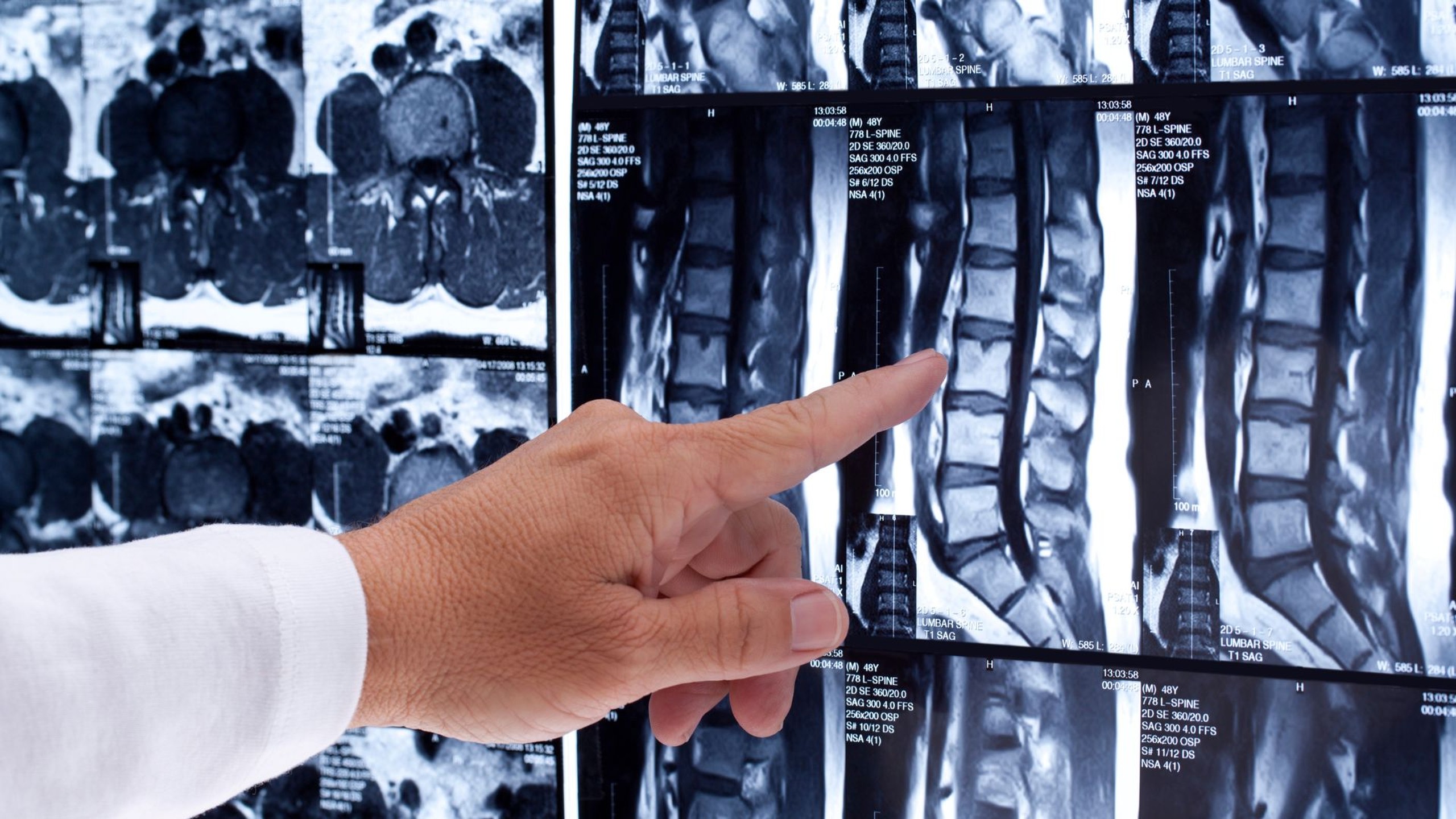 Chụp MRI cột sống là gì? Khi nào cần chụp và chi phí bao nhiêu?