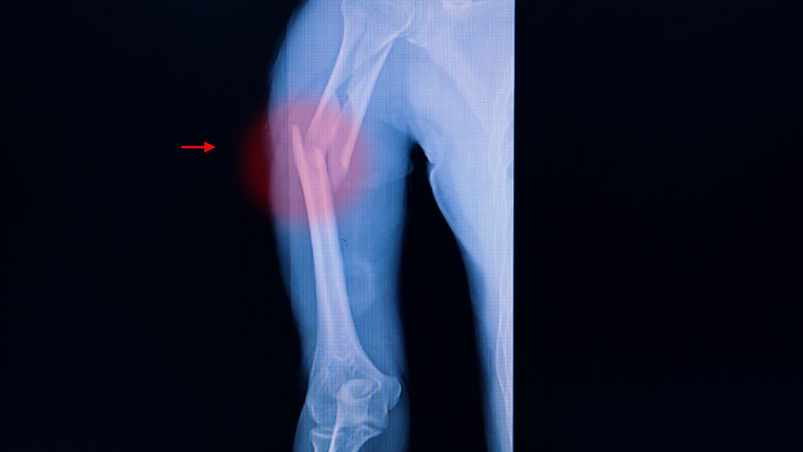 Gãy trên lồi cầu xương cánh tay: Nguyên nhân, điều trị và phục hồi