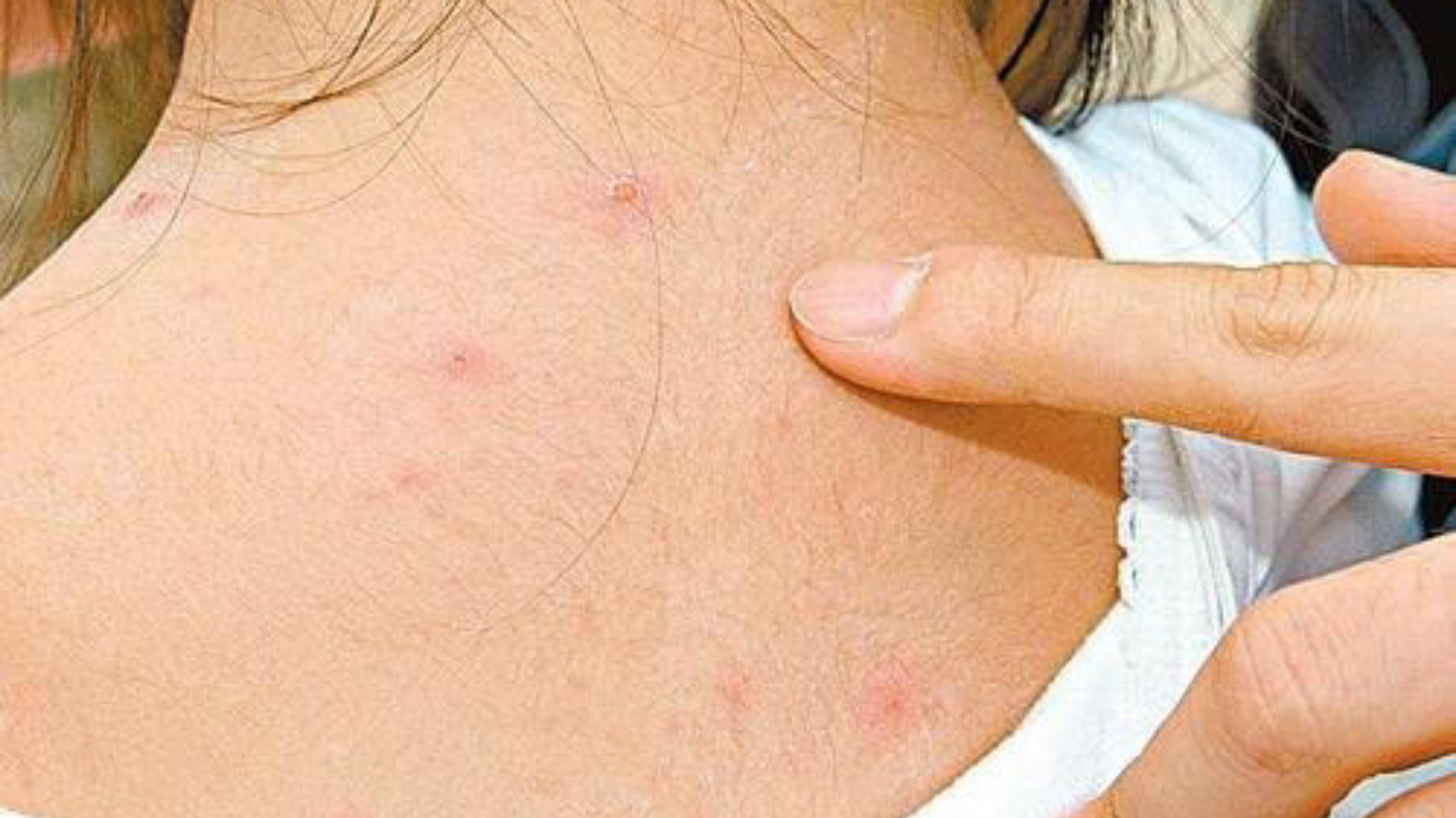 Hình ảnh bệnh thủy đậu ở trẻ em qua từng giai đoạn tiến triển bệnh 2