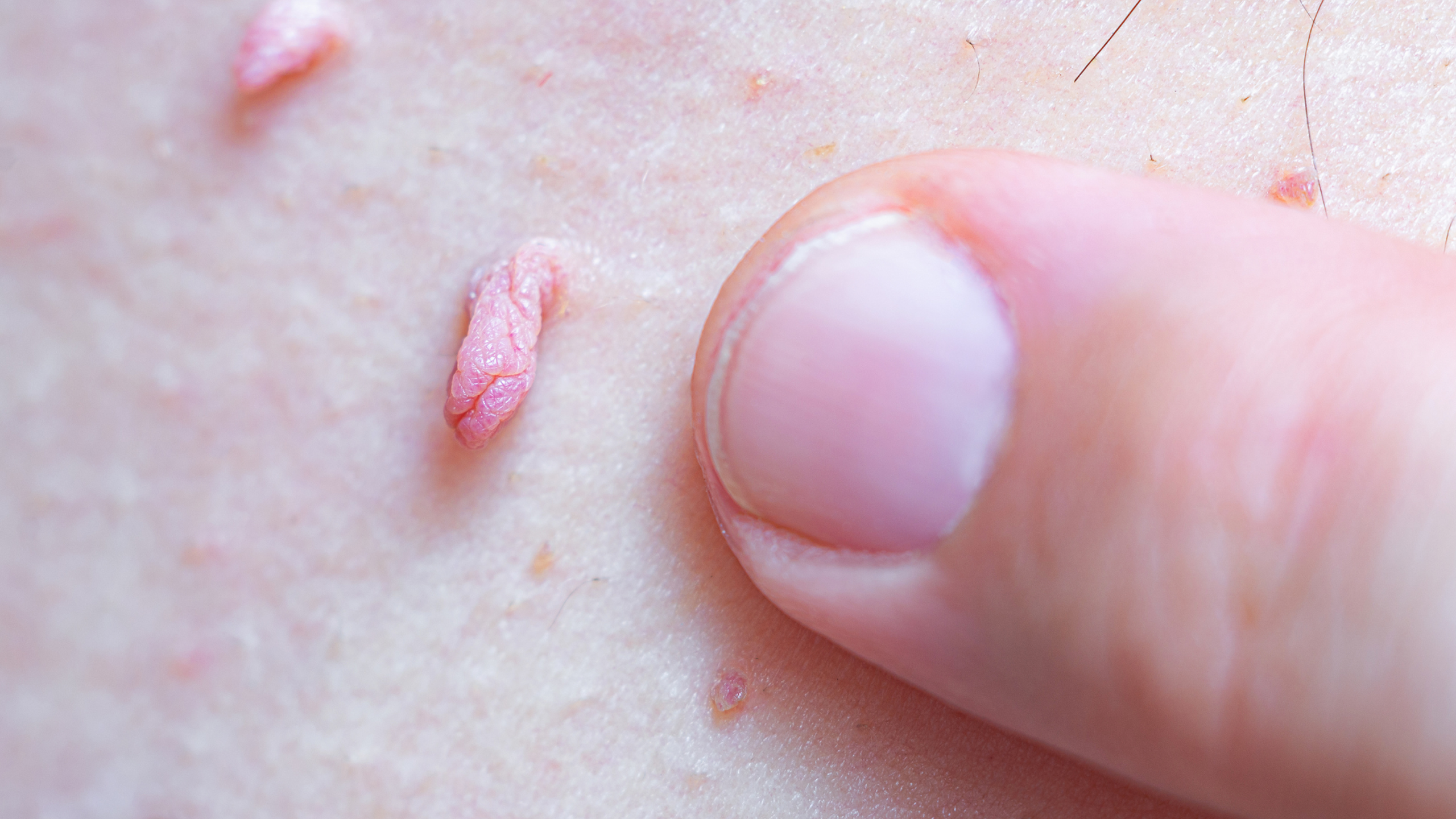Nguyên nhân nhiễm virus HPV và cách phòng ngừa lây nhiễm 2