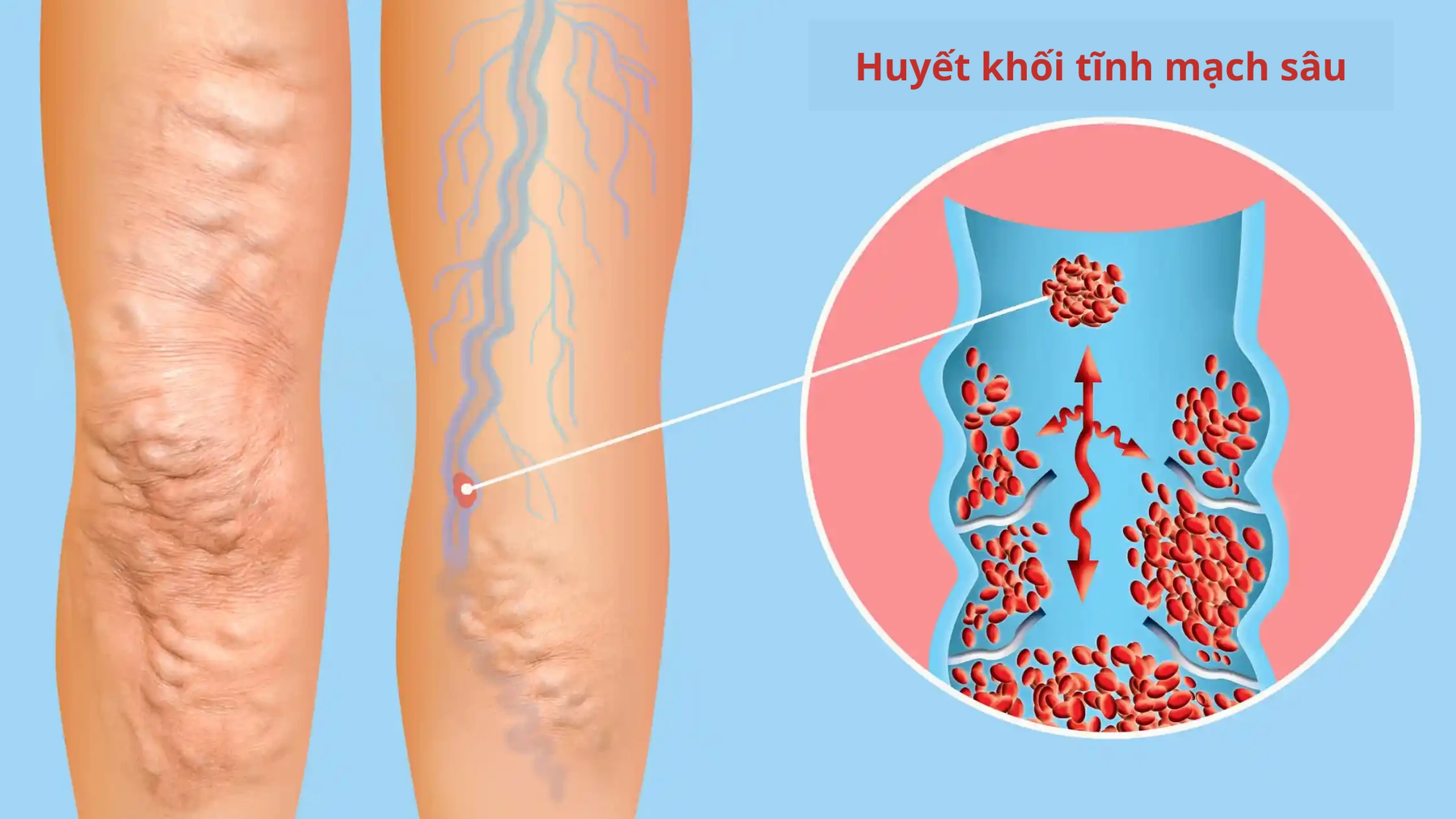 Huyet_khoi_tinh_mach_sau_1_ebe44a5444