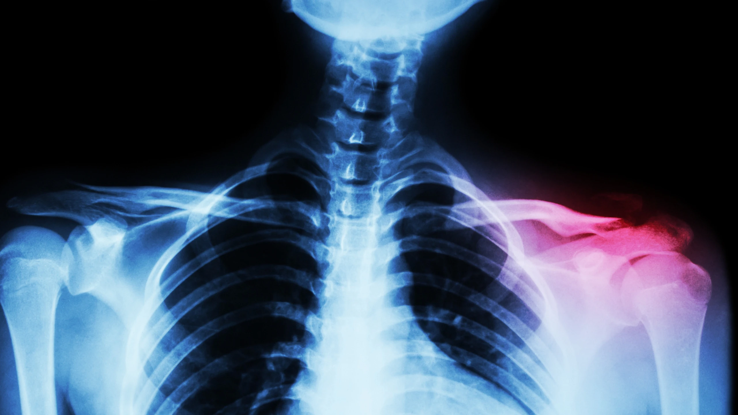 benh_a_z_gay_xuong_don_b8070e1a1b