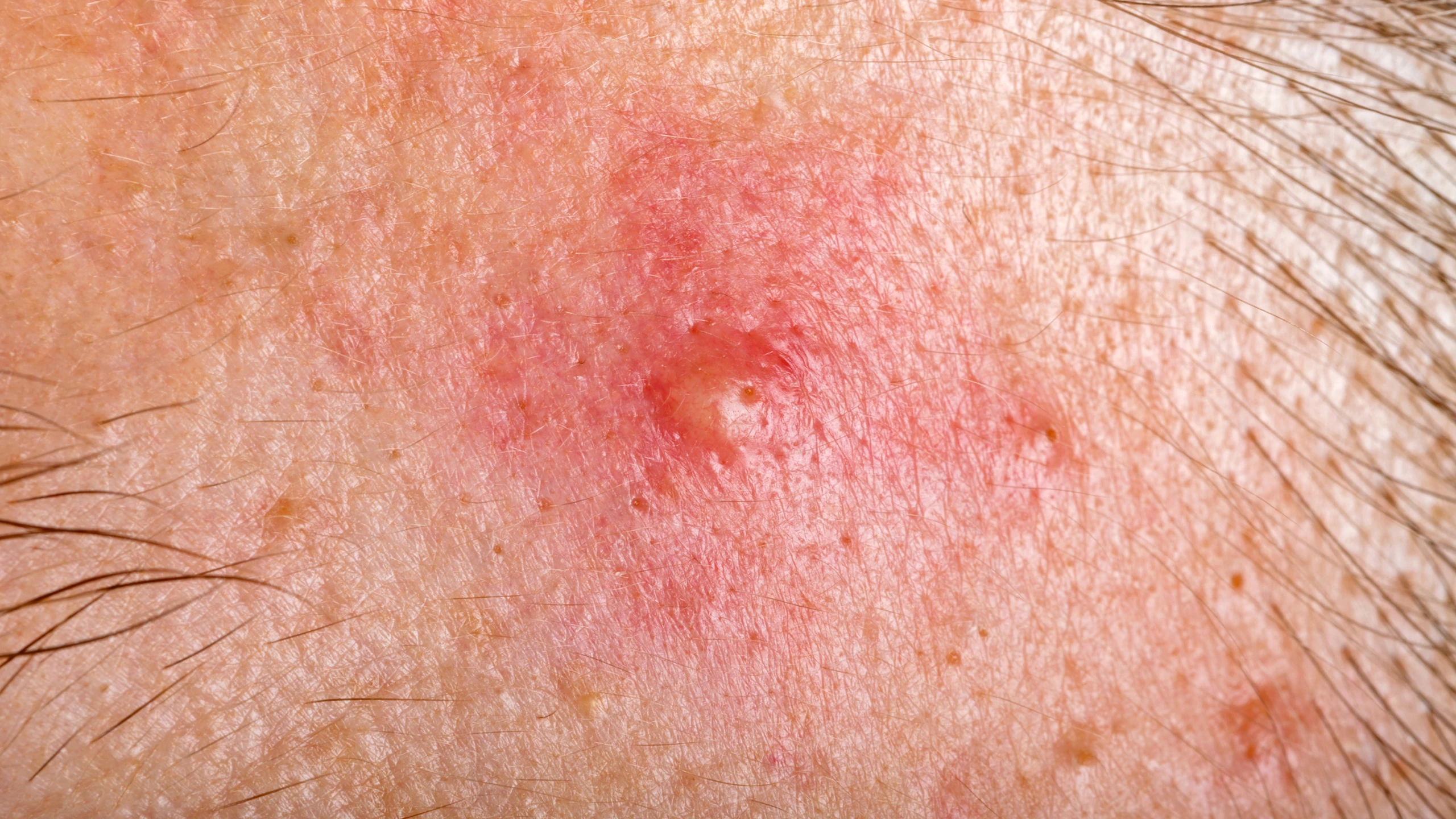 benh_a_z_mun_boc_b67273364b