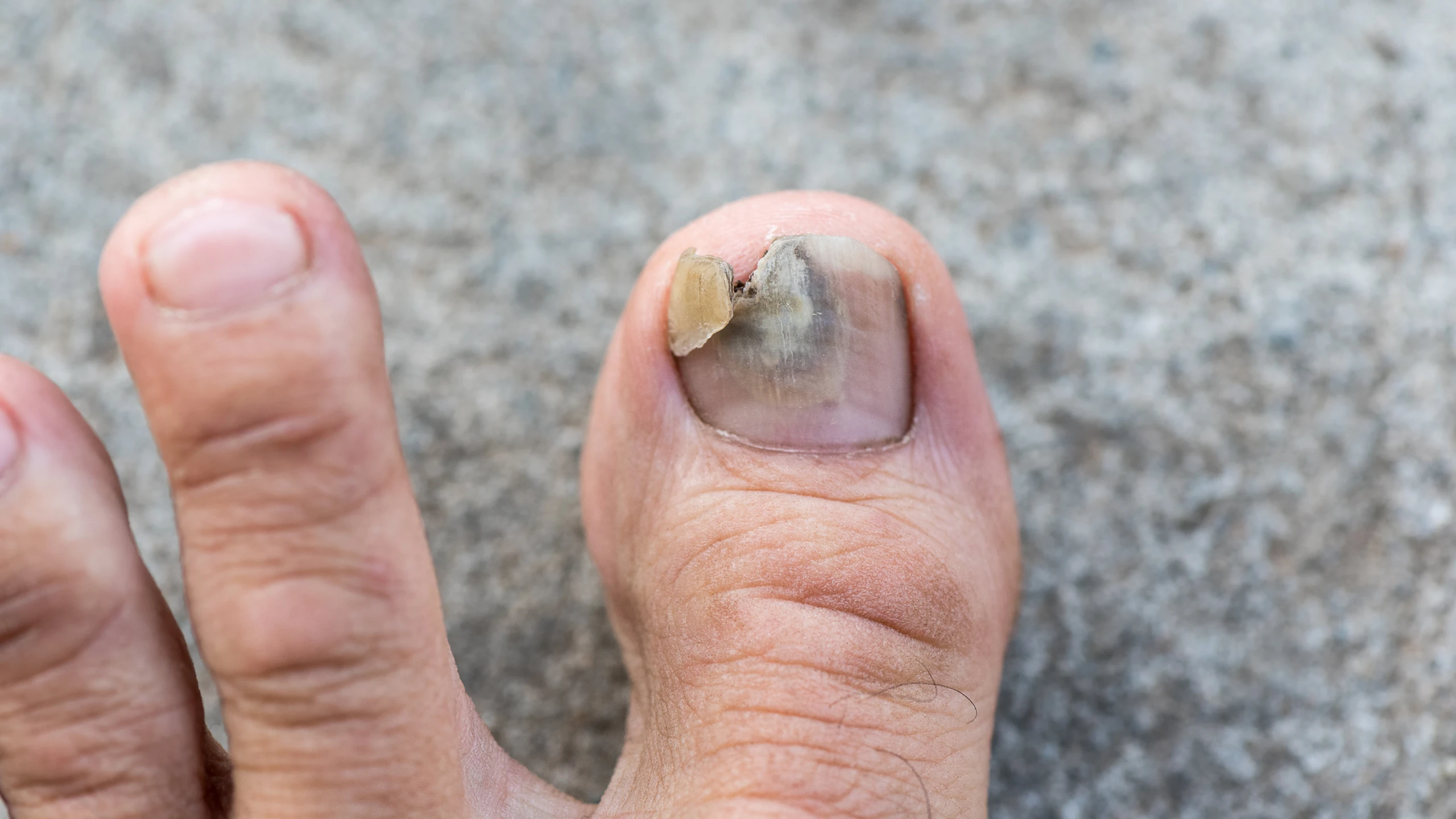 benh_a_z_nam_mong_chan_5e36dfe1b0