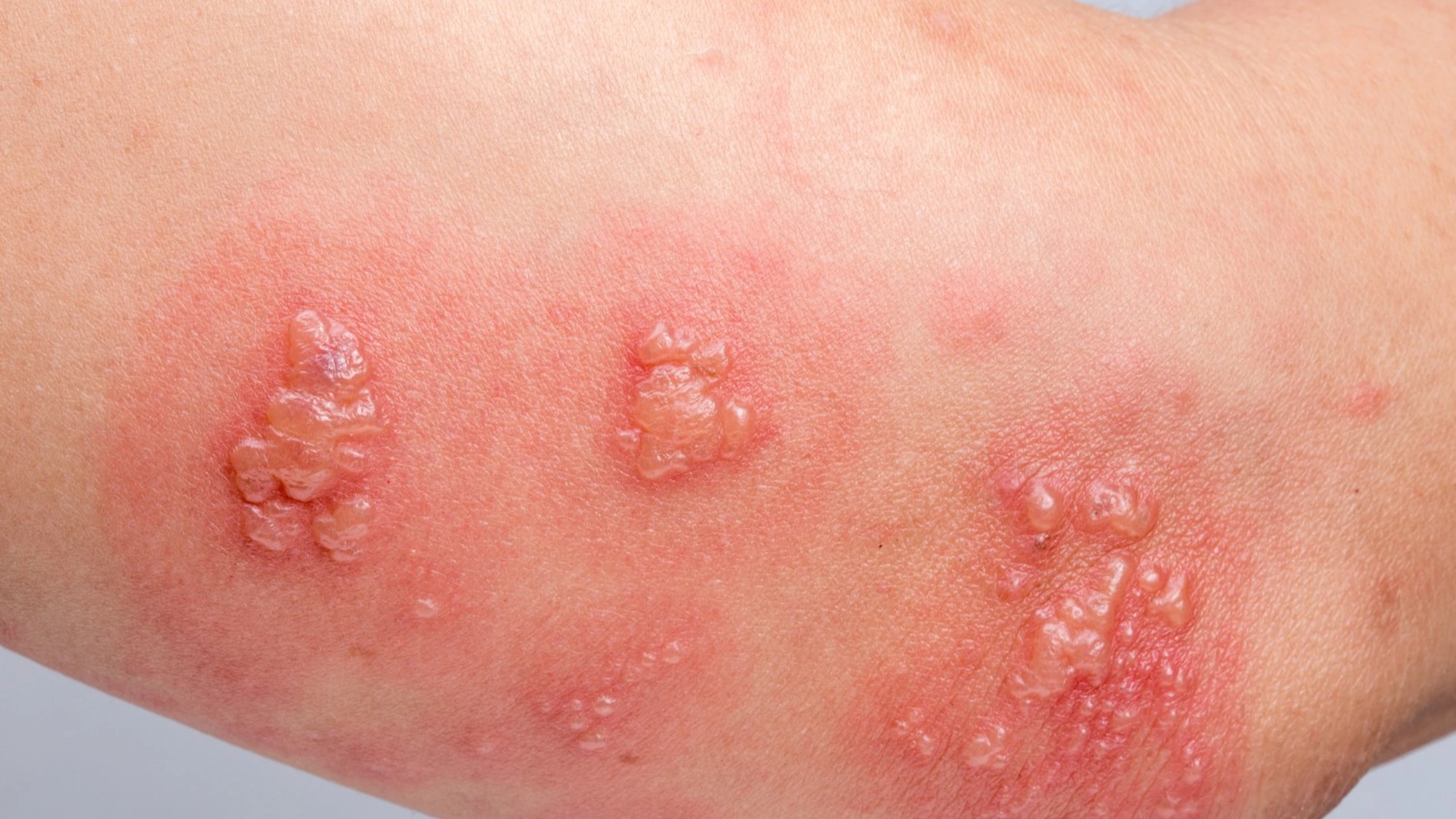 benh_a_z_rop_da_86647ce718