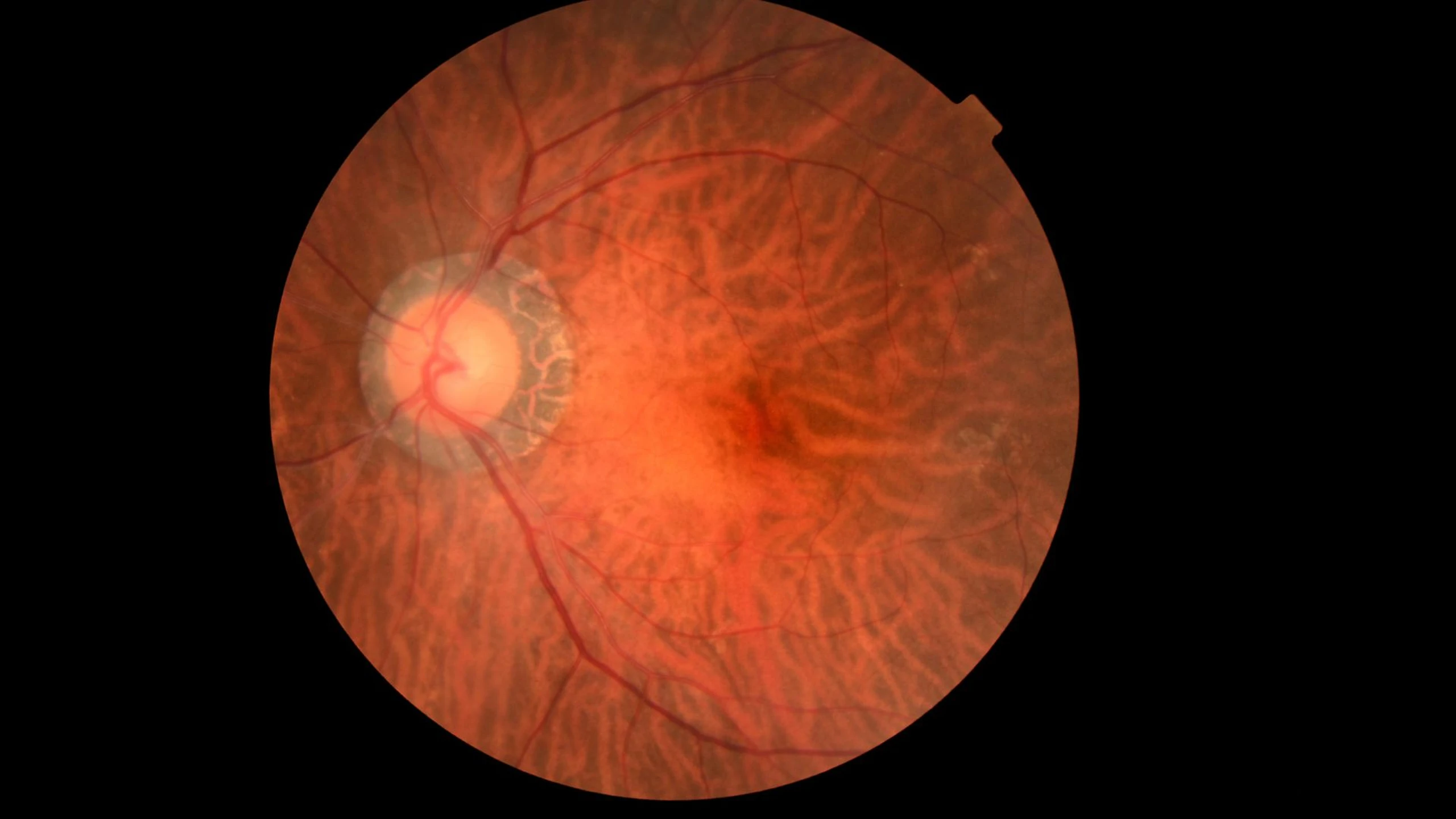 benh_a_z_u_nguyen_bao_vong_mac_1_f846bb3f4d