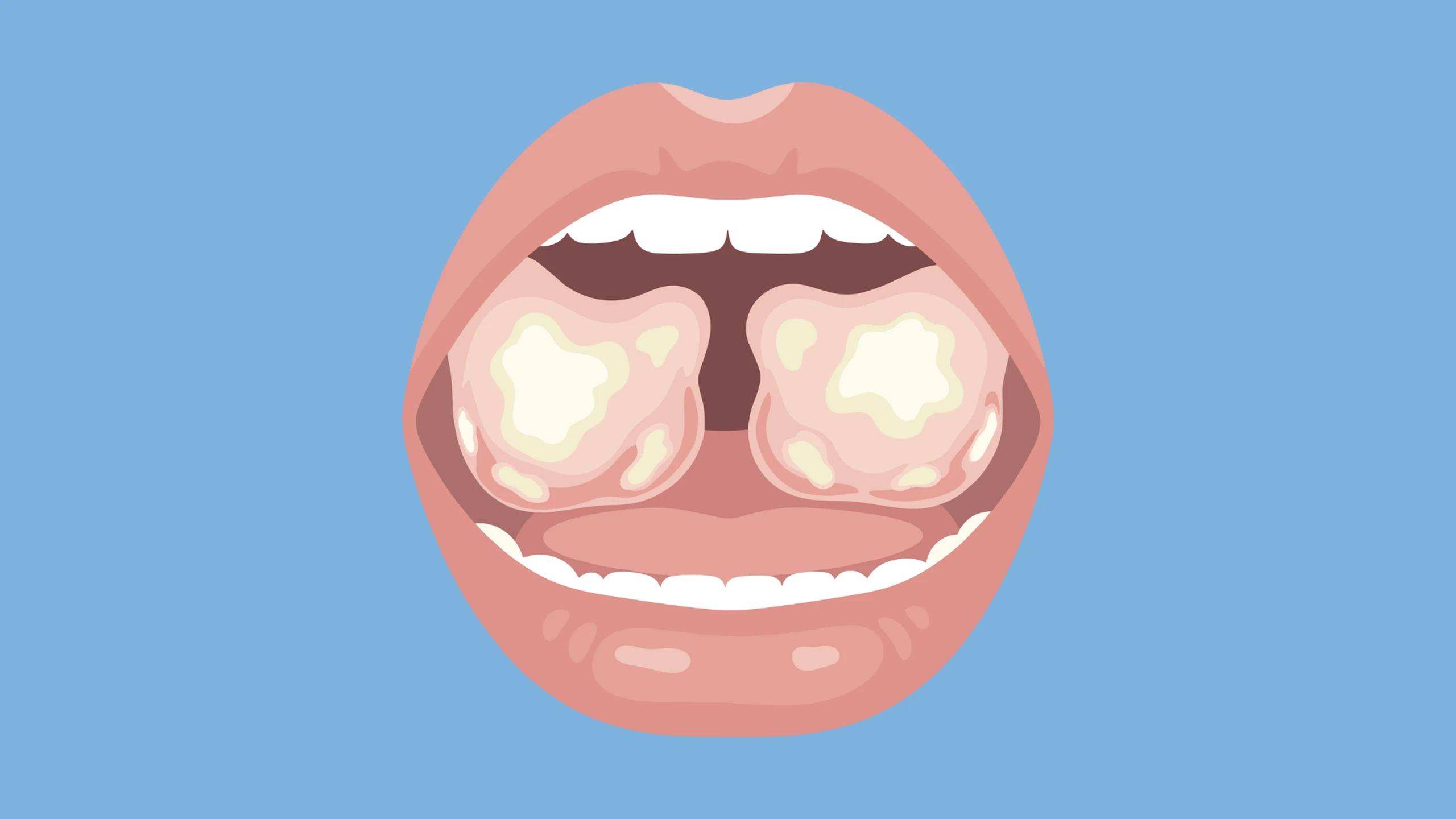 benh_a_z_viem_amidan_hoc_mu_a29134d6da