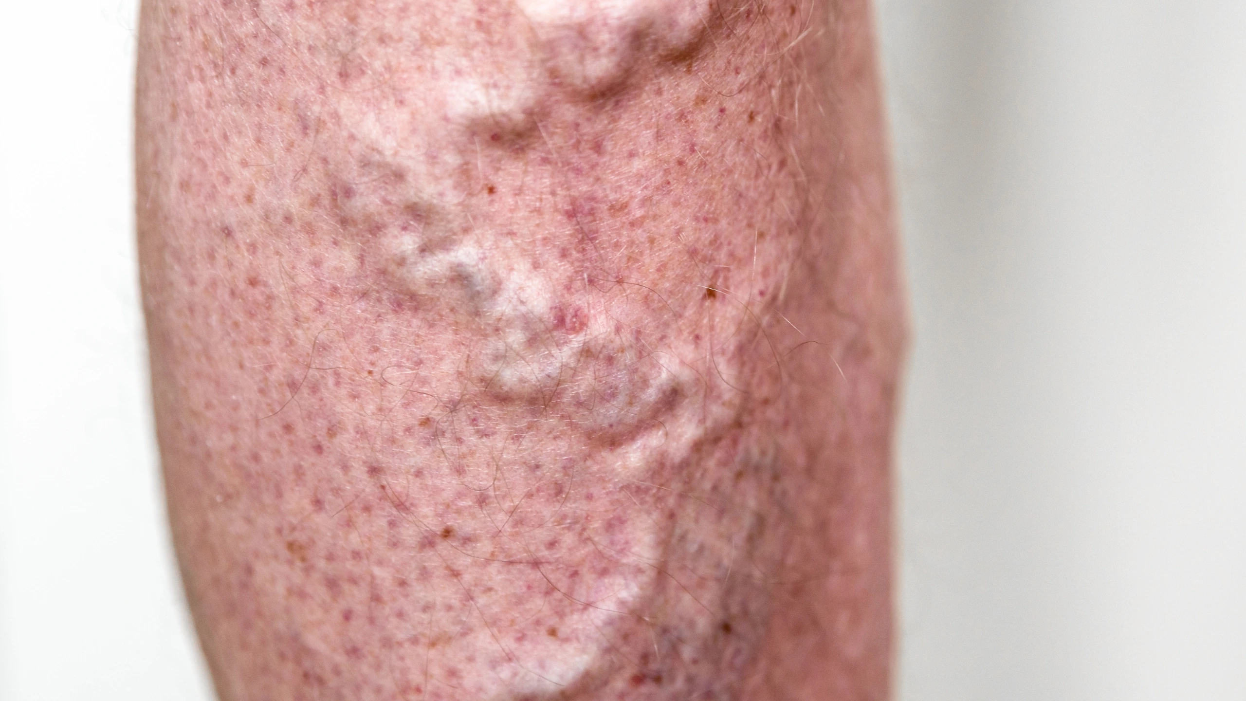 benh_a_z_viem_tinh_mach_5ac864d16a