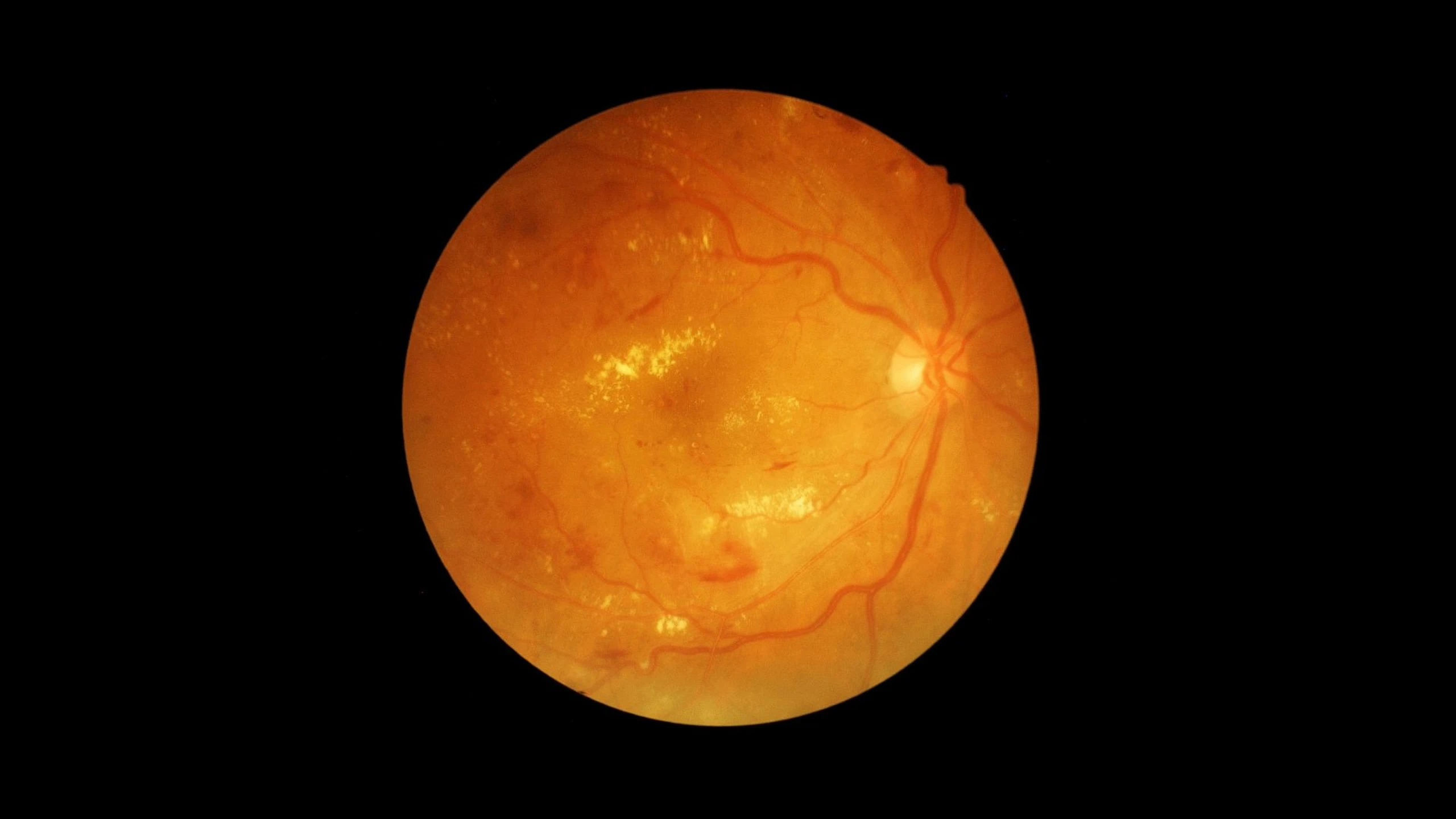 benh_a_z_vong_mac_tieu_duong_1_36340ba36b