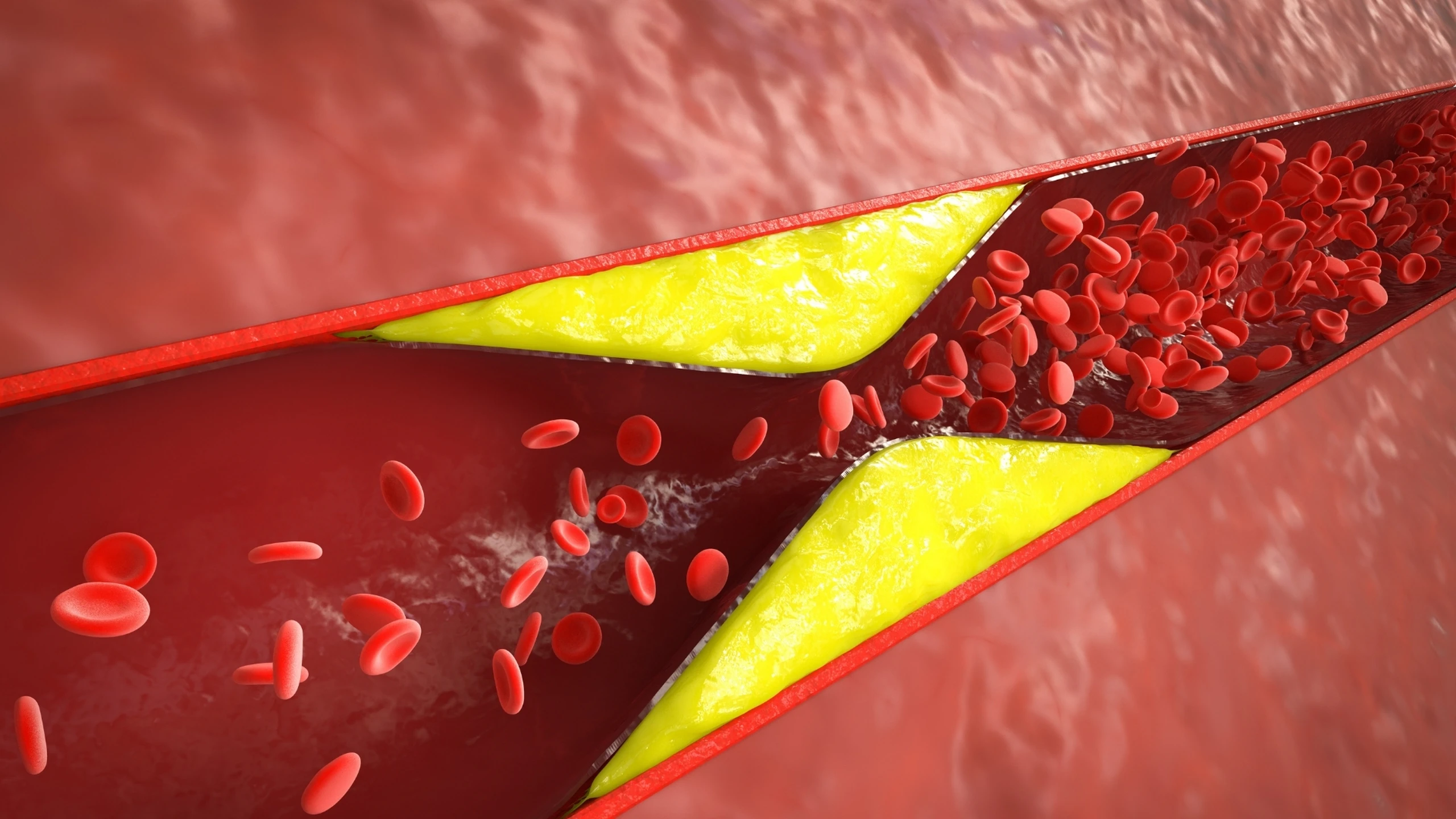 benh_a_z_xo_vua_dong_mach_0_81246982ec