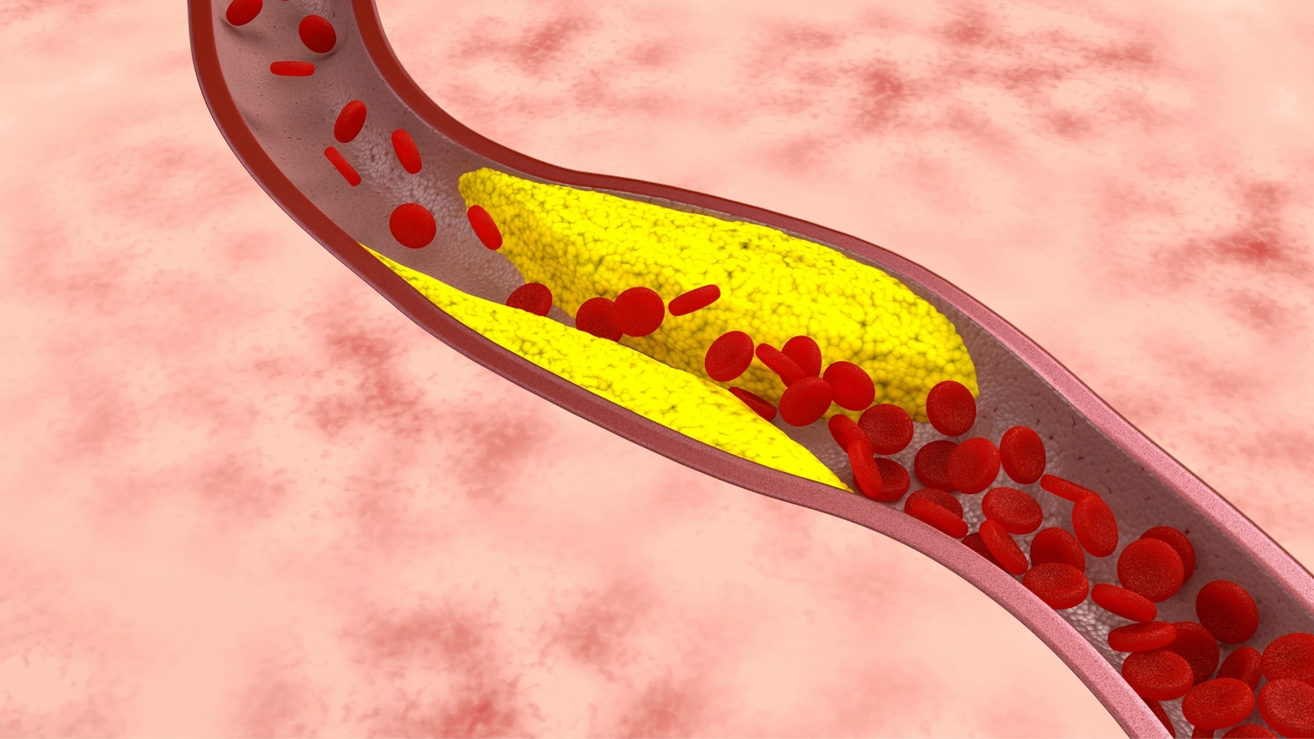 benh_a_z_xo_vua_dong_mach_chu_bung_0_262ae38b58