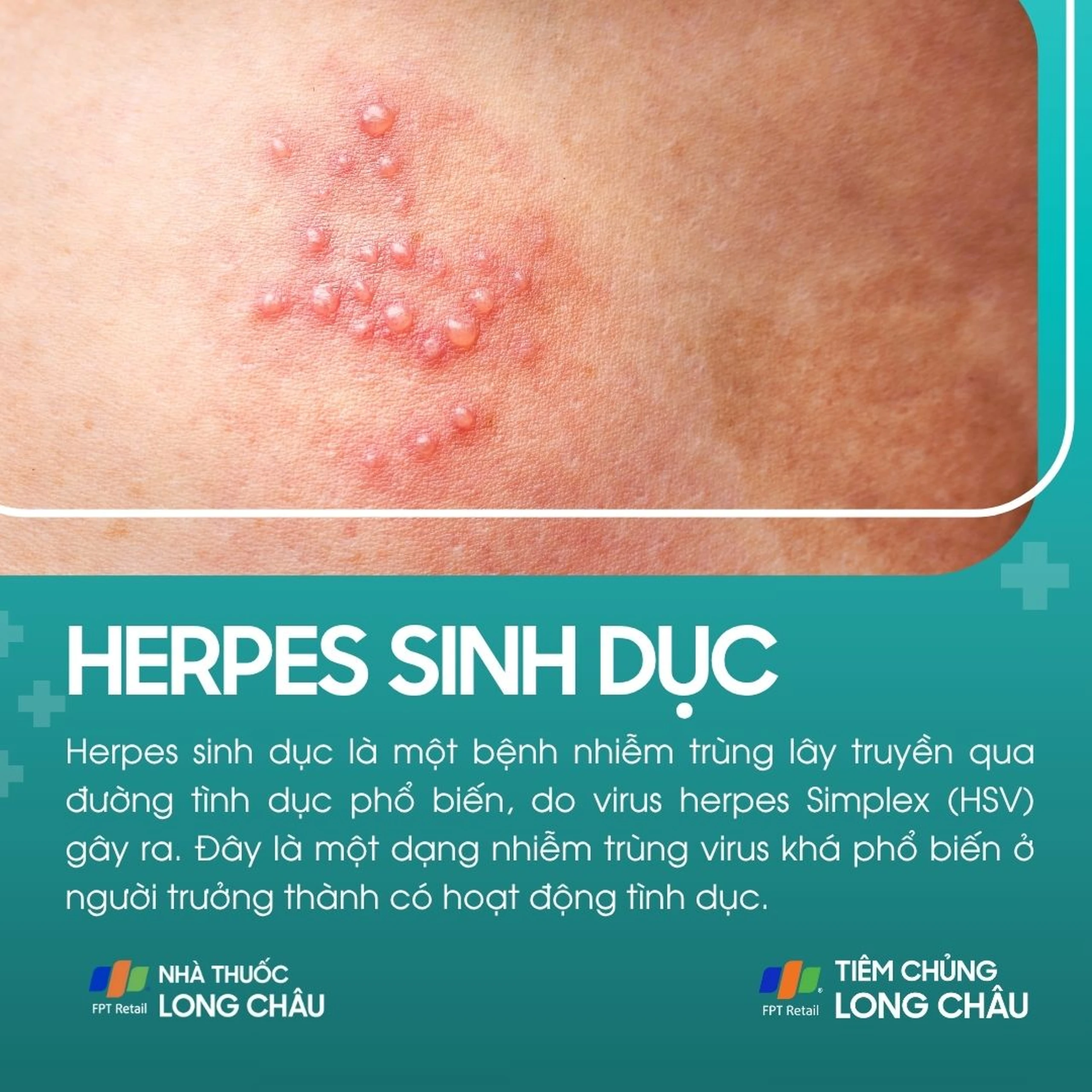 herpes_sinh_duc_1_e866c29b7b
