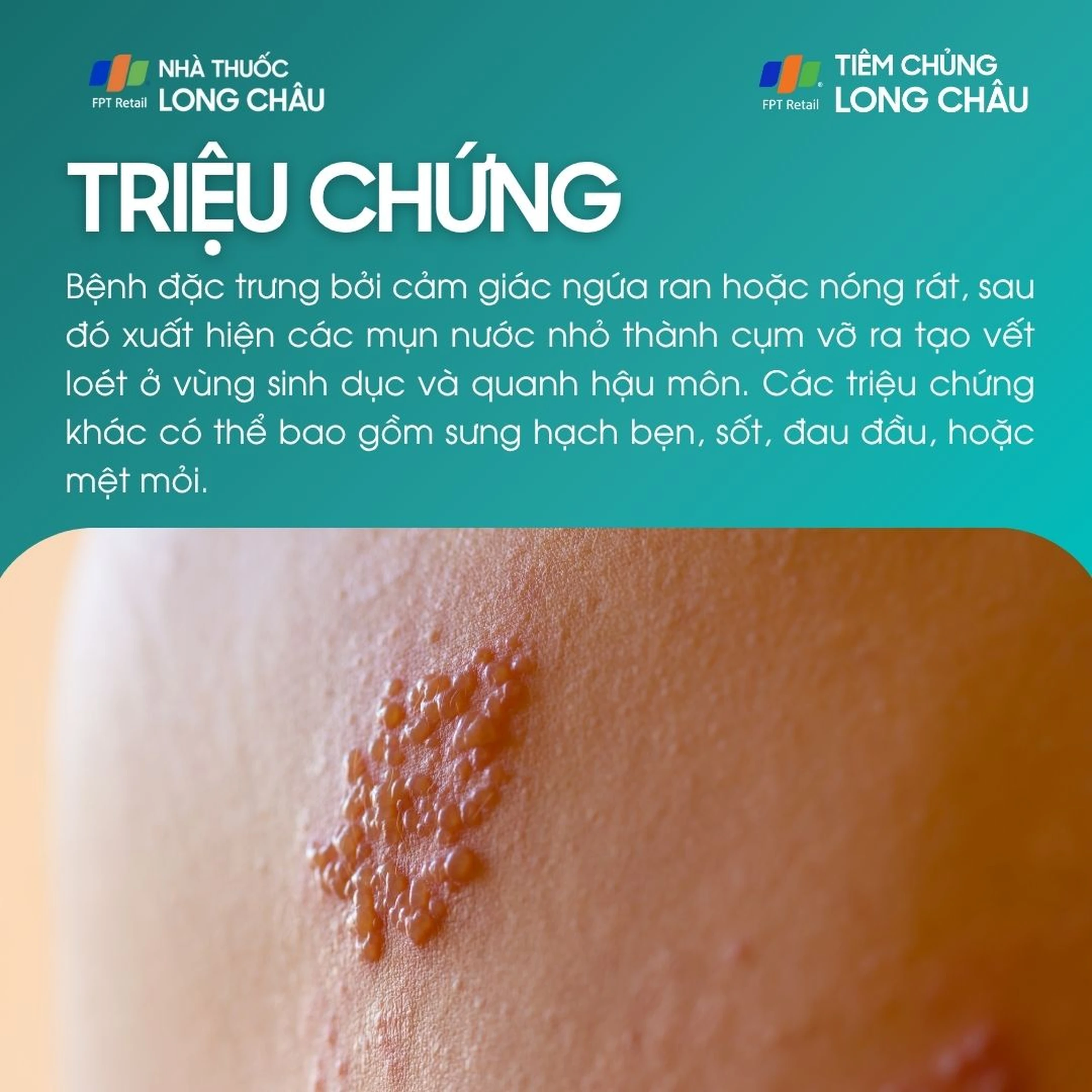 herpes_sinh_duc_2_e9017bdfdd