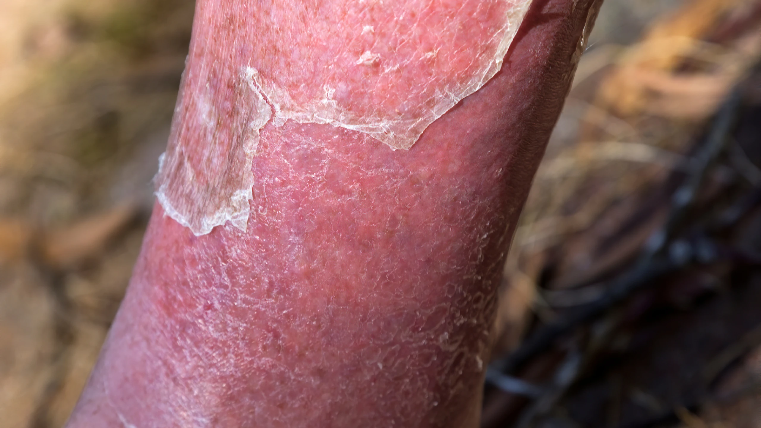 viem_mo_te_bao_0f7c09371b