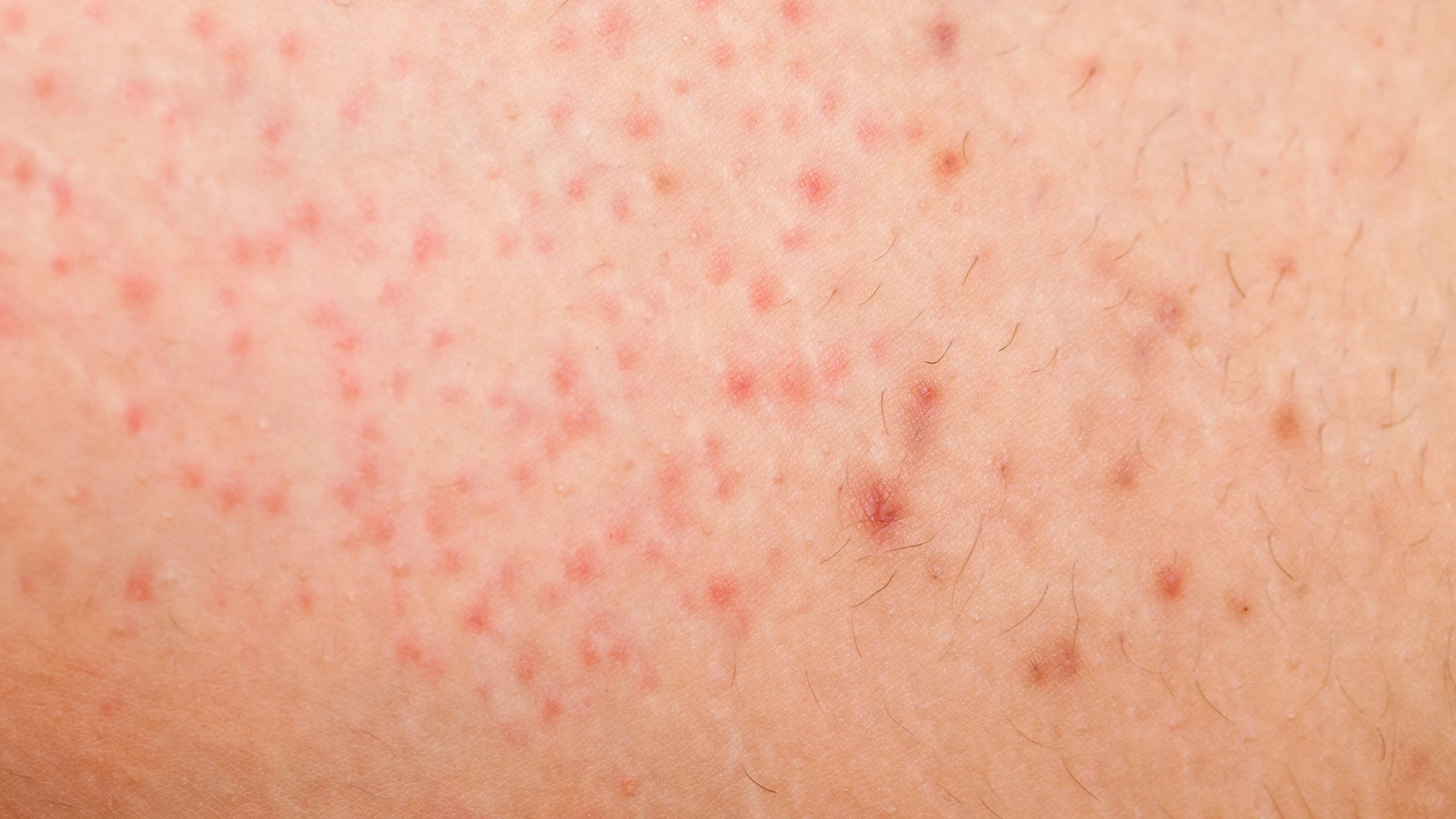 viem_nang_long_26ea718586