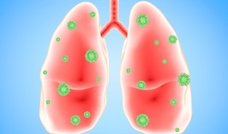Nhiễm trùng phổi là gì? Nguyên nhân và các triệu chứng điển hình