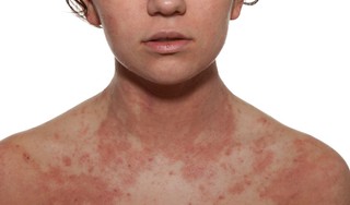 Cách chữa viêm da cơ địa hiệu quả và an toàn