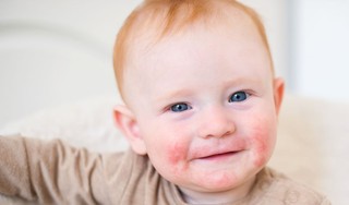 Hình ảnh viêm da cơ địa ở trẻ em và cách để chăm sóc trẻ