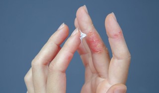 Viêm da cơ địa ở tay là gì? Cách chăm sóc để hạn chế tái phát