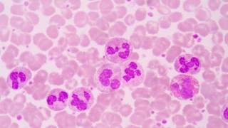 Bạch cầu mono tăng: Nguyên nhân, triệu chứng và cách điều trị