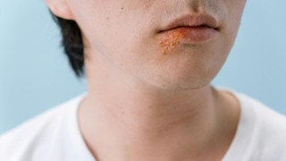 Bị giời leo ở miệng bôi gì để nhanh khỏi? Hướng dẫn điều trị và phòng ngừa