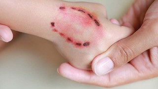 Bị người cắn có sao không? Khi nào cần đi khám ngay?