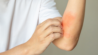 Da bị ngứa gãi nổi hột​ là do đâu? Có cách nào khắc phục không?