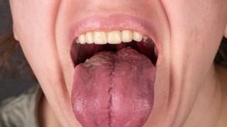 Dấu hiệu ung thư khoang miệng: 10 cảnh báo sớm dễ bị bỏ qua