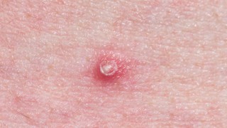 Khi cậu nhỏ nổi mụn trắng không ngứa​ có nguy hiểm không?