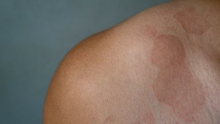 Lang ben đỏ: Nguyên nhân, triệu chứng và cách phòng ngừa