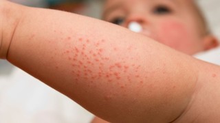 Phát ban có tiêm phòng được không? Hướng dẫn chi tiết đảm bảo an toàn y tế