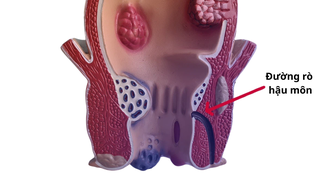 Rò hậu môn ở trẻ sơ sinh: Nguyên nhân, dấu hiệu và hướng điều trị