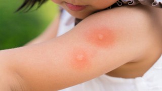 Vết côn trùng cắn sưng đỏ ngứa có sao không? Hướng xử trí và phòng ngừa hiệu quả