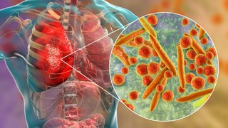 Viêm phổi do bội nhiễm là gì? Nguyên nhân, dấu hiệu và cách phòng ngừa