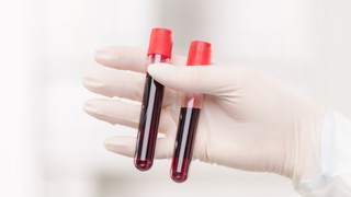 Xét nghiệm máu có phát hiện ung thư gan không? Làm thế nào để chẩn đoán ung thư gan chính xác?