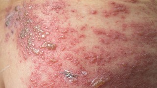 Zona thần kinh ở bụng có đặc điểm gì? Biện pháp để phòng ngừa bệnh