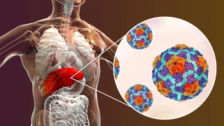 Triệu chứng nhiễm virus viêm gan A và cách phòng ngừa hiệu quả