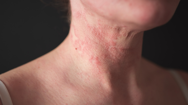Hình ảnh viêm da cơ địa người lớn và cách chăm sóc hiệu quả