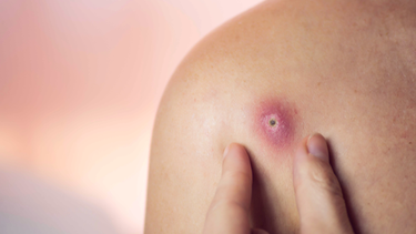 Vết thương áp xe bao lâu thì lành? Cách chăm sóc hiệu quả