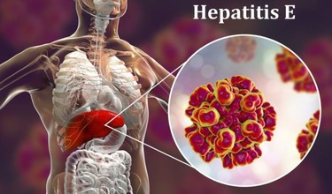 Viêm gan E có lây không? Đường lây truyền virus viêm gan E cần biết