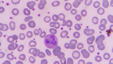 Tỷ lệ bạch cầu lympho tăng là gì? Nguyên nhân, dấu hiệu cần biết