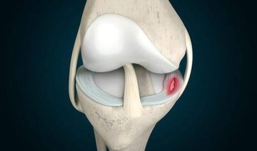 Rách sụn chêm đầu gối là gì? Nguyên nhân và hướng điều trị hiện nay