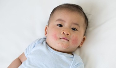 Trẻ sơ sinh bị rôm sảy ở mặt do nguyên nhân gì? Cách xử lý an toàn