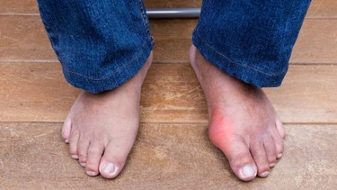 Dấu hiệu viêm khớp ngón chân và cách phòng ngừa hiệu quả