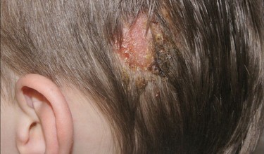 Bệnh nấm da đầu có lây không? Nguyên nhân và cách phòng ngừa