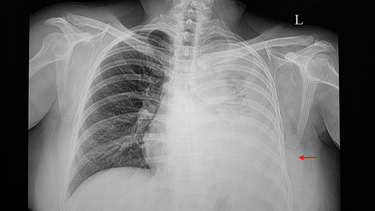 Tràn dịch màng phổi ác tính: Nguyên nhân, triệu chứng, điều trị 