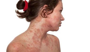 Viêm da cơ địa có lây không? Cách điều trị và chăm sóc