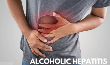 Viêm gan do rượu là gì và có các phương pháp điều trị nào?