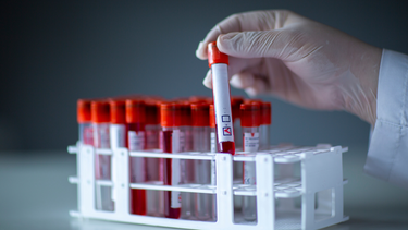 ASLO dương tính có sao không? Những lưu ý cần biết khi xét nghiệm