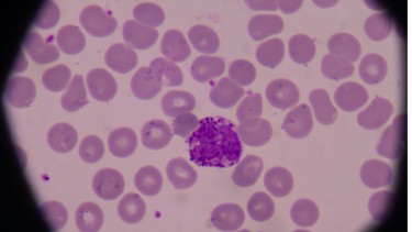 Bạch cầu ái kiềm: Vai trò, chỉ số bình thường và những vấn đề sức khỏe liên quan